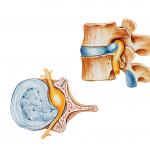 Sintomas e tratamento da mielopatia compressiva da coluna cervical Mielopatia com exacerbação dos sintomas da osteocondrose cervical